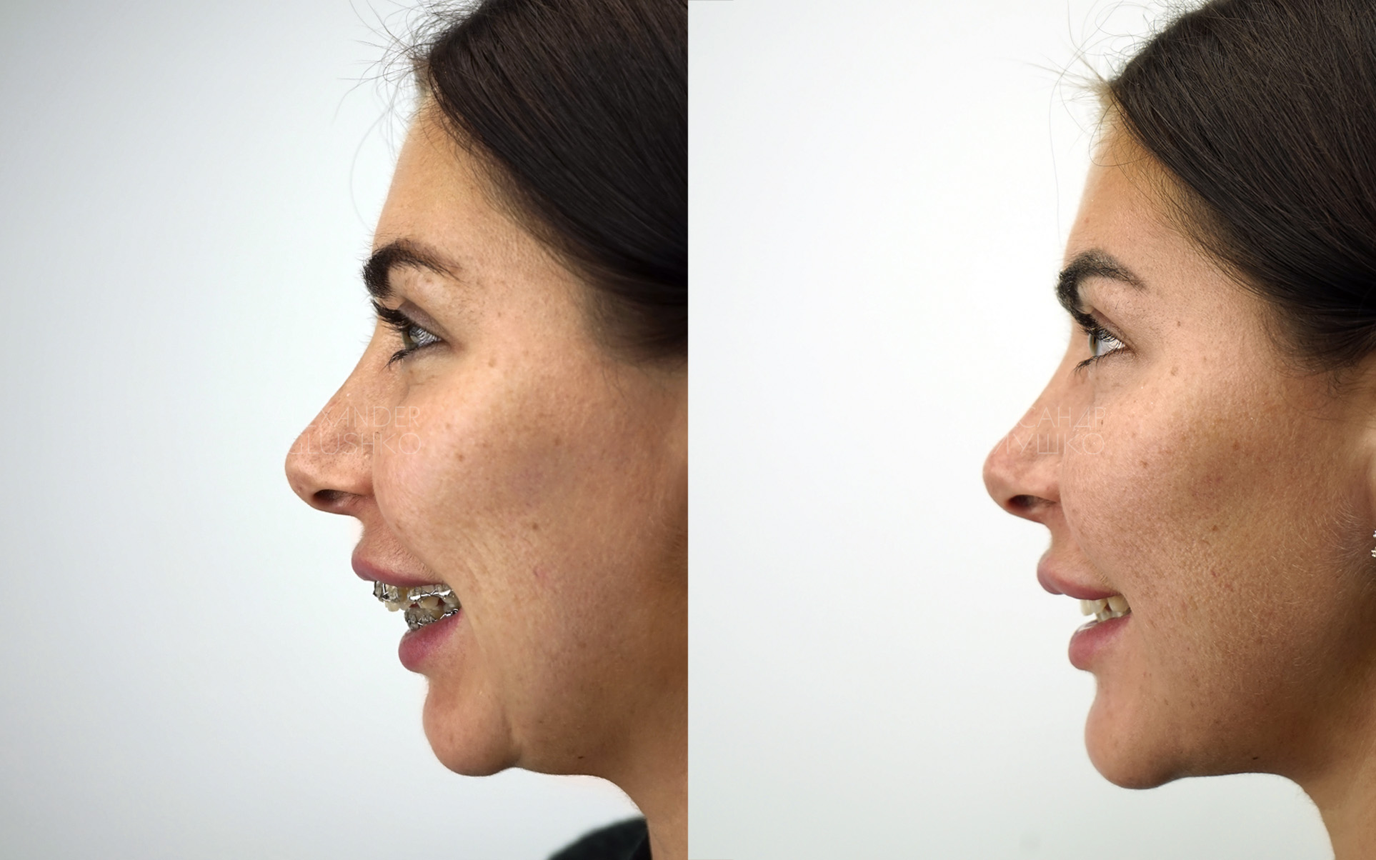 Ортогнатия