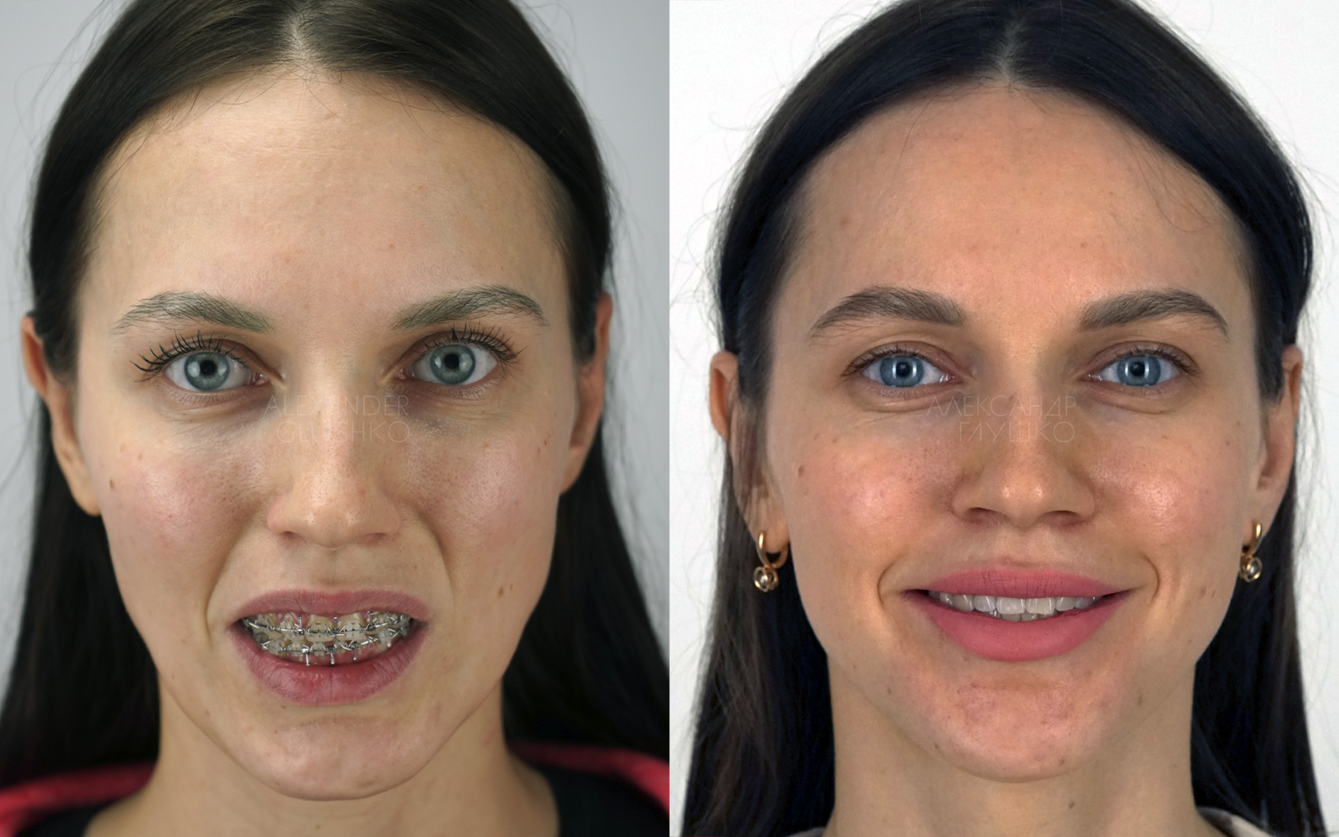 Ортогнатия