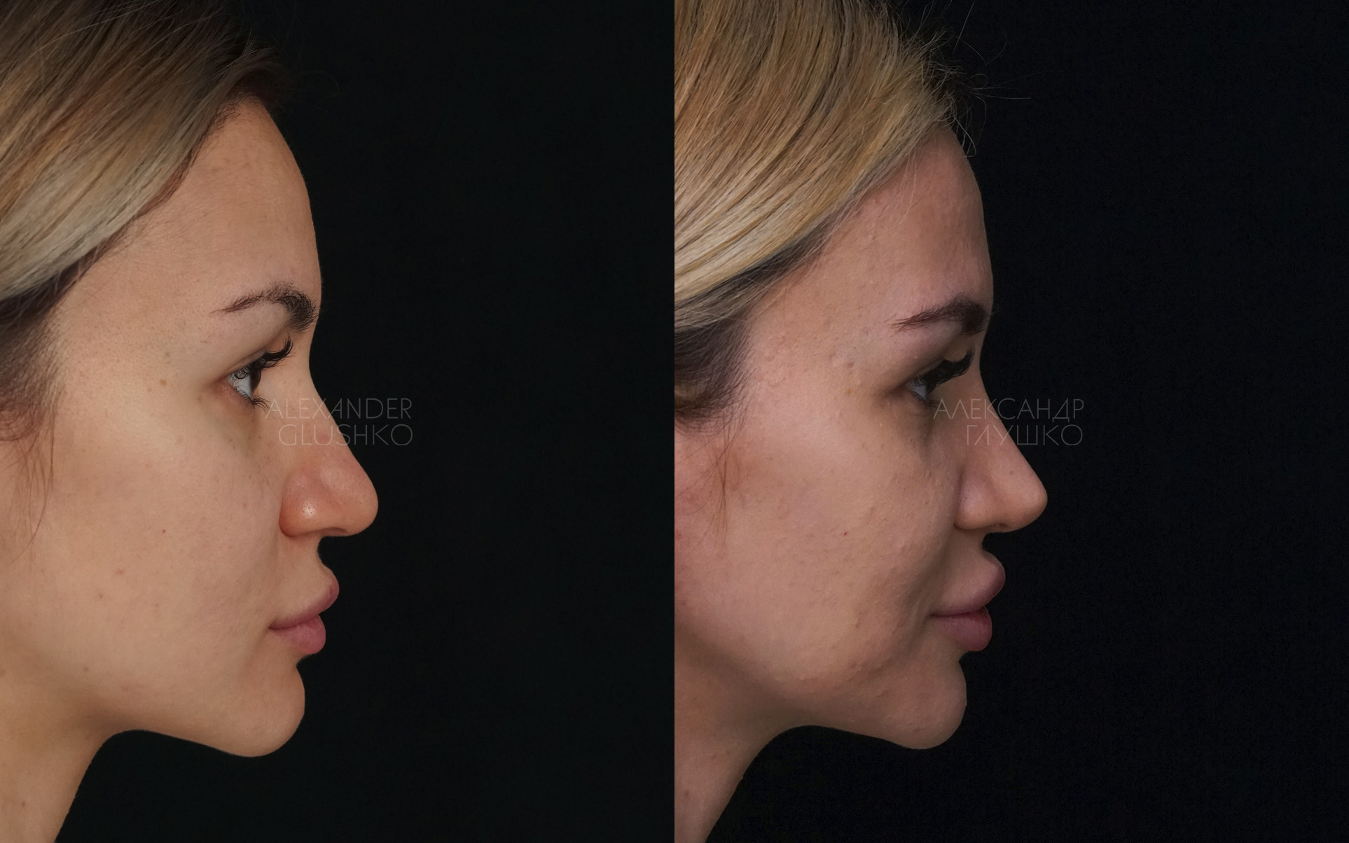 сужение носа ботоксом до и после фото