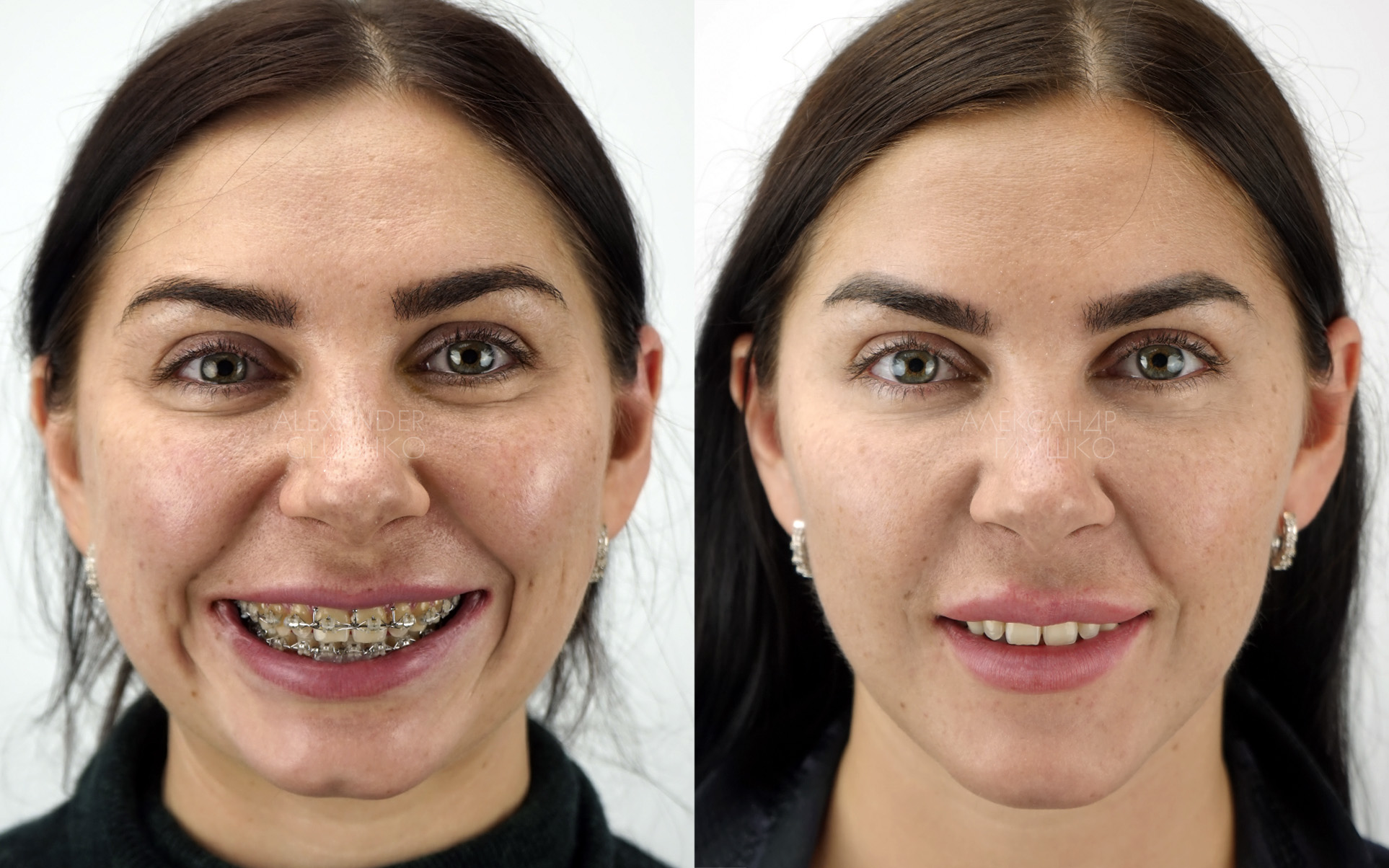 Ортогнатия